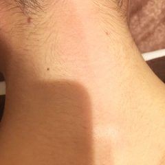 うなじワックス脱毛